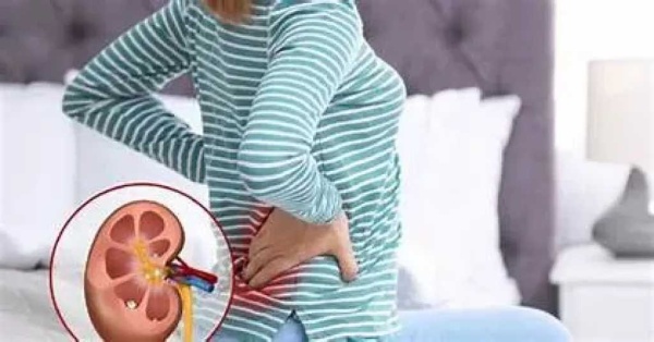 5 طرق منزلية تساعد في التخلص من حصوات الكلى والوقاية منها 5 طرق منزلية تساعد في التخلص من حصوات الكلى والوقاية منها
