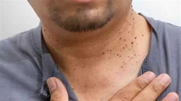 أسباب الزوائد الجلدية متى تكون طبيعية ومتى تستدعي زيارة الطبيب أسباب الزوائد الجلدية متى تكون طبيعية ومتى تستدعي زيارة الطبيب