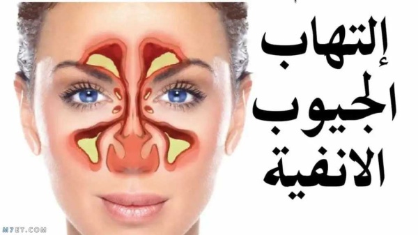 لا تتجاهل التهاب الجيوب الأنفية أعراض بسيطة قد تخفي مضاعفات خطيرة تستدعي العلاج لا تتجاهل التهاب الجيوب الأنفية أعراض بسيطة قد تخفي مضاعفات خطيرة تستدعي العلاج