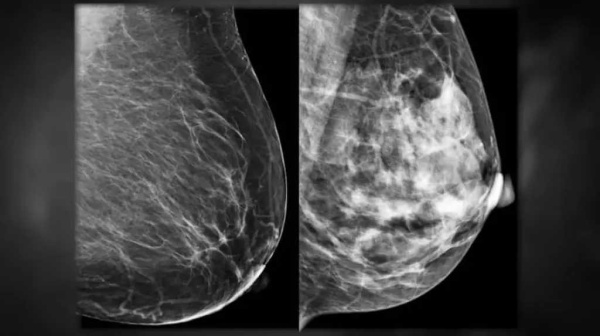 أطباء أورام يحذرون من 3 أعراض للسرطان لا يجب تجاهلها التشخيص المبكر يصنع الفارق