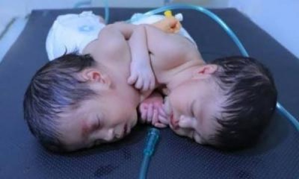 وفاة توأم سيامي جراء استمرار الحصار على مطار صنعاء الدولي وفاة توأم سيامي جراء استمرار الحصار على مطار صنعاء الدولي