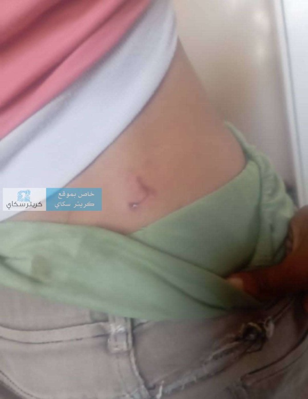 عاجل إصابة طفل بعضة كلب ي شتبه بإصابته بالسعار في التربة ومطالبات بتحرك عاجل عاجل إصابة طفل بعضة كلب ي شتبه بإصابته بالسعار في التربة ومطالبات بتحرك عاجل