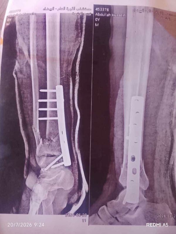 بعد عملية عظام مثيرة للجدل دعوات لمحاسبة المسؤولين في المستشفى