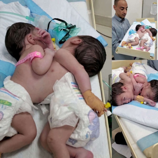 توأمان سياميان يصلان صنعاء قادمين من هذه المحافظة