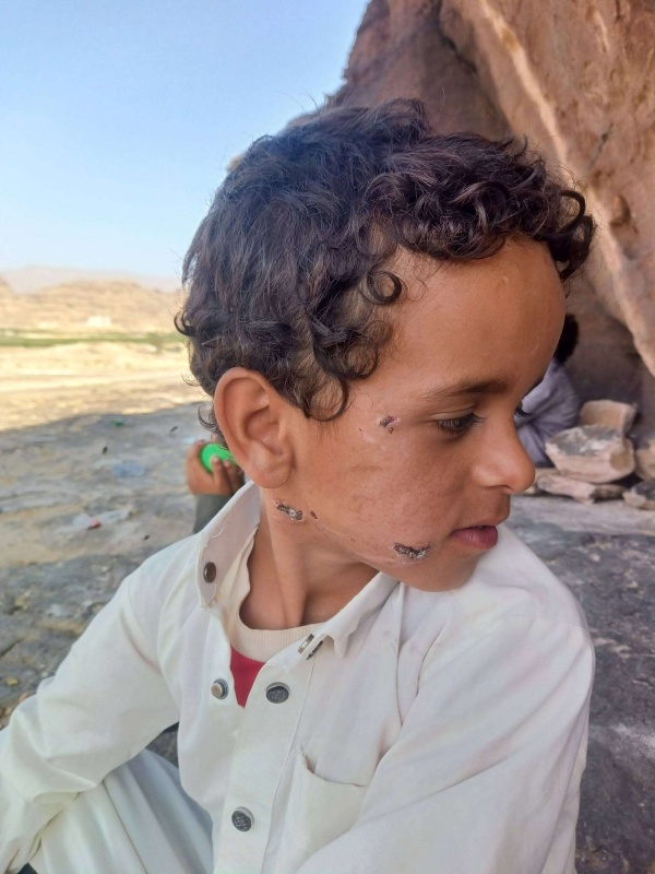 بعد عضة كلب طفل في صعدة يتلقى اللقاحات ثم تظهر عليه أعراض داء الكلب بعد 21 يوم ا بعد عضة كلب طفل في صعدة يتلقى اللقاحات ثم تظهر عليه أعراض داء الكلب بعد 21 يوم ا