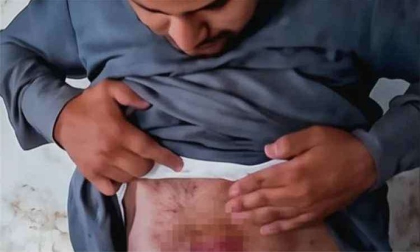 تعذيب مواطن داخل سجن حو ثي بصعدة وسط مطالبات بالكشف عن مصيره تعذيب مواطن داخل سجن حو ثي بصعدة وسط مطالبات بالكشف عن مصيره