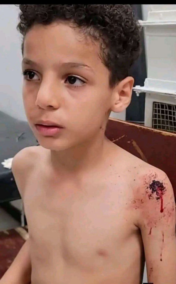 إصابة طفل بشظية جراء قذيفة حوثية إصابة طفل بشظية جراء قذيفة حوثية
