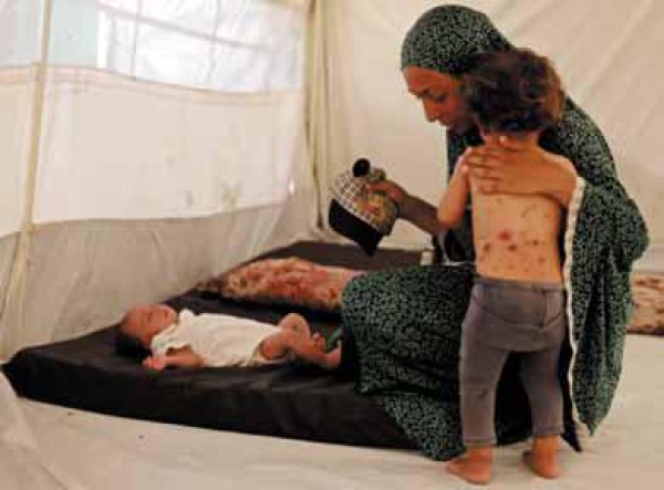 خيام النزوح في غزة جدري الماء يفاقم معاناة النازحين وسط نقص العلاج