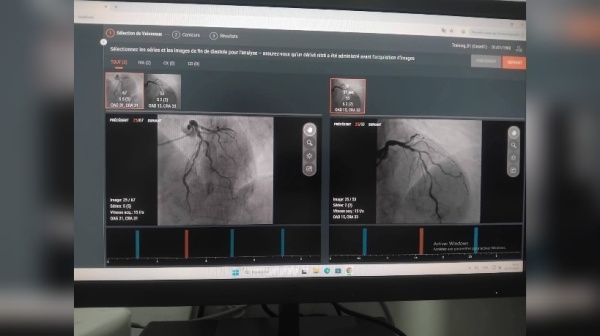 مدنين لأول مرة تركيب وتشغيل برنامج تحليل qfr بالمستشفى الجامعي مدنين لأول مرة تركيب وتشغيل برنامج تحليل qfr بالمستشفى الجامعي