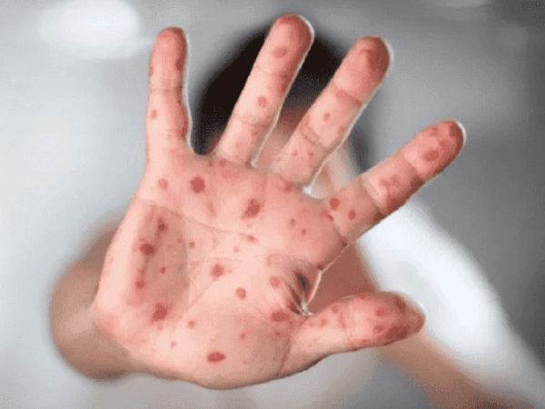 تحذيرات من تفشي جدري الماء بين أطفال غزة تحذيرات من تفشي جدري الماء بين أطفال غزة