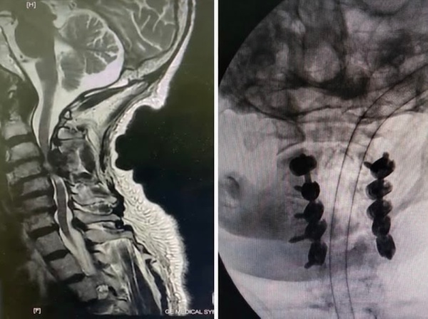 5 ساعات الملك سلمان الطبية تنهي شلل ا رباعي ا لسبعيني 5 ساعات الملك سلمان الطبية تنهي شلل ا رباعي ا لسبعيني
