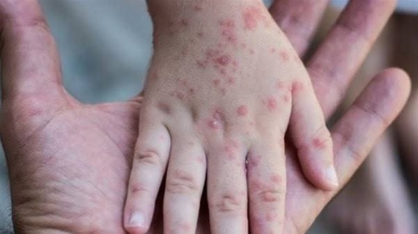 ارتفاع عدد الإصابات بالحصبة في ولاية بنسلفانيا الأمريكية إلى 460 حالة ارتفاع عدد الإصابات بالحصبة في ولاية بنسلفانيا الأمريكية إلى 460 حالة