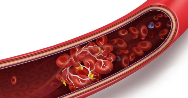 89 من المرضى تلقوا مذيب الجلطات خلال 30 دقيقة