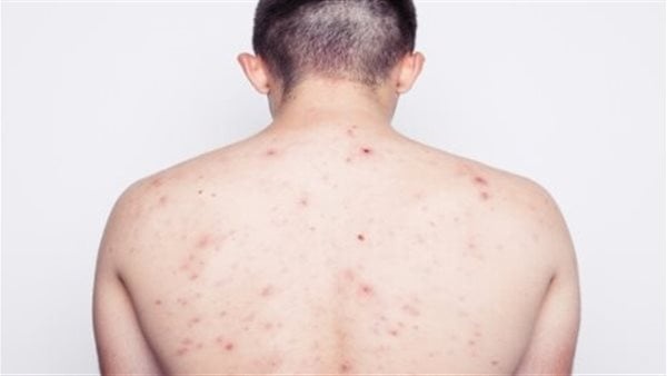 ظهور حبوب صغيرة في الذراعين ما أسبابها وكيف يمكن التعامل معها