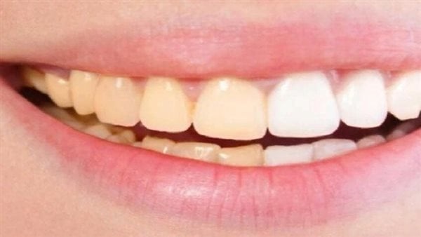 أسباب تغير لون الأسنان وطرق استعادة بياضها