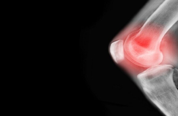 دراسة إسبانية تبشر بفرصة جديدة للوقاية من التهاب المفاصل الروماتويدي دراسة إسبانية تبشر بفرصة جديدة للوقاية من التهاب المفاصل الروماتويدي