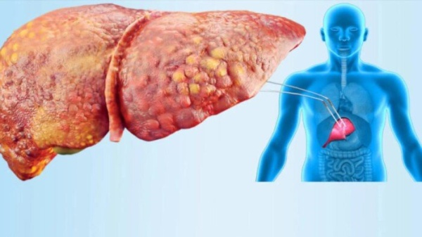 نهج جديد لعلاج الكبد الدهني إصلاح الأمعاء أول ا بدل ا من استهداف الكبد مباشرة نهج جديد لعلاج الكبد الدهني إصلاح الأمعاء أول ا بدل ا من استهداف الكبد مباشرة