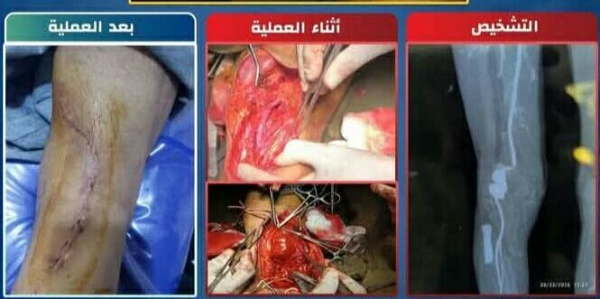 نجاح عملية دقيقة في مستشفى الثورة بالحديدة نجاح عملية دقيقة في مستشفى الثورة بالحديدة