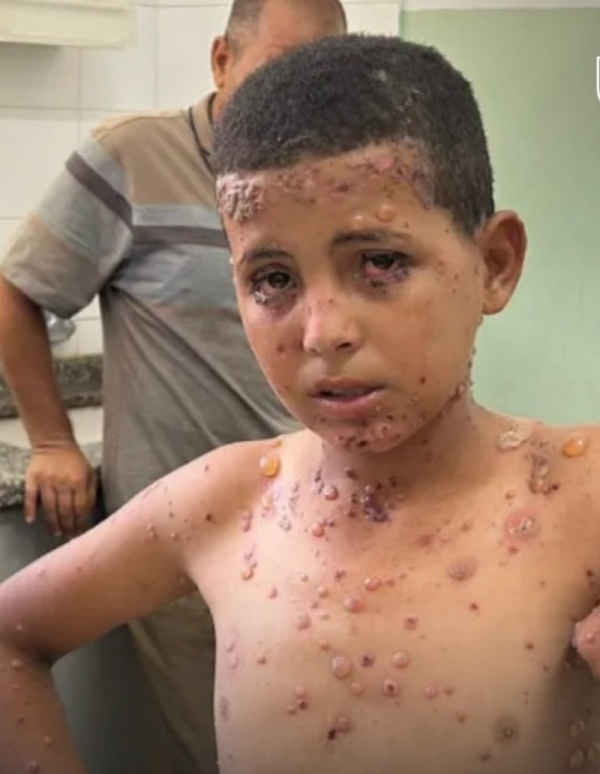 البرش جدري الماء يتحول إلى وباء في غزة مع تسجيل 58 ألف إصابة