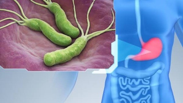 7 مكونات طبيعية قد تساعد في مكافحة جرثومة المعدة الكركم والثوم في المقدمة