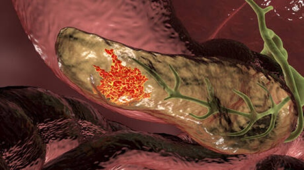 نموذج ذكاء اصطناعي يتنبأ بسرطان البنكرياس قبل 3 سنوات من التشخيص نموذج ذكاء اصطناعي يتنبأ بسرطان البنكرياس قبل 3 سنوات من التشخيص