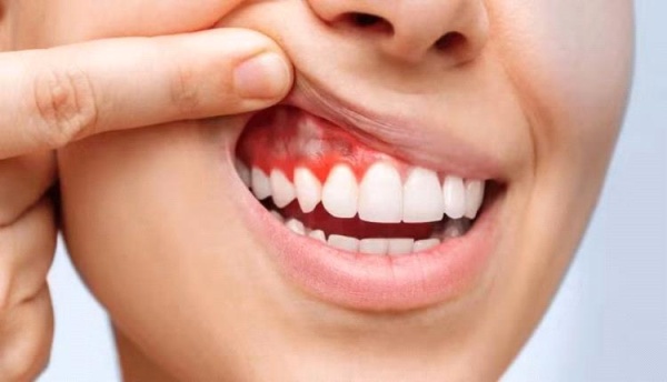 هذه الأطعمة تقلل خطر أمراض اللثة والأسنان تعرف عليها هذه الأطعمة تقلل خطر أمراض اللثة والأسنان تعرف عليها