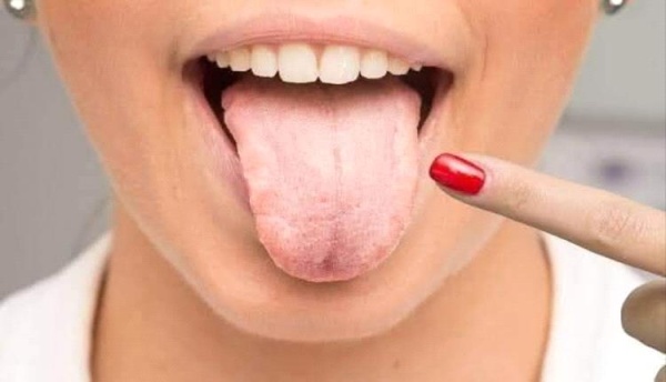 تغيرات في اللسان قد تشير إلى الإصابة بالسرطان تغيرات في اللسان قد تشير إلى الإصابة بالسرطان