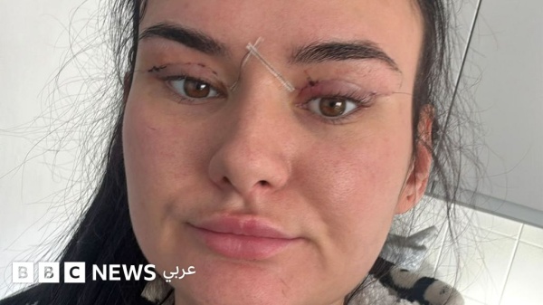كيف تصبح بعض عمليات رأب الجفون وصفة لكارثة