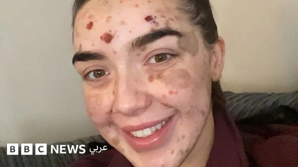 بشرتي تجعلني مميزة وأتعلم تقب لها بشرتي تجعلني مميزة وأتعلم تقب لها