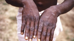 monkeypox case count rises to more than 3 200 globally who
