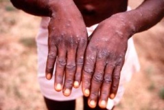 croatia reports first case of monkeypox infection