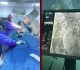 منزل بورقيبة نجاح أول عملية لتركيب دعامة للأبهر الصدري النازل endoprothese aortique