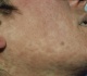 us measles cases hit 35 year high